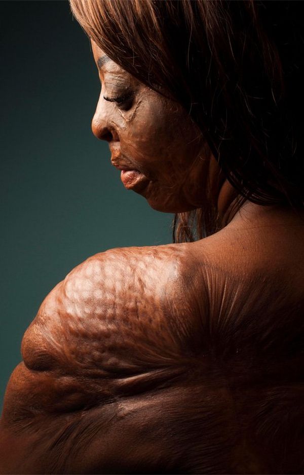 A woman with back turned to the camera, has heavy scarring on her back and face.